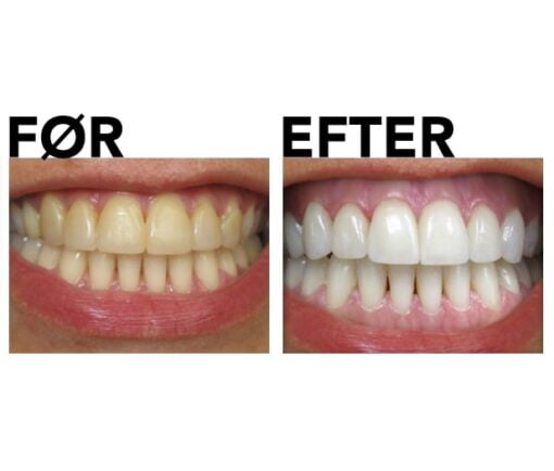 Tandblekningssæt før og efter gennemgangsbillede