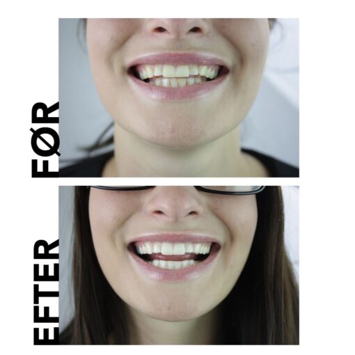 naturlig tandblegning tandpasta før og efter
